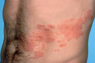 shingles vaccine