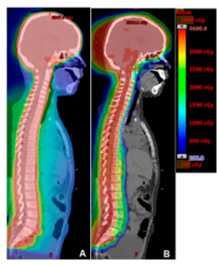 Proton Therapy Vs Radiation